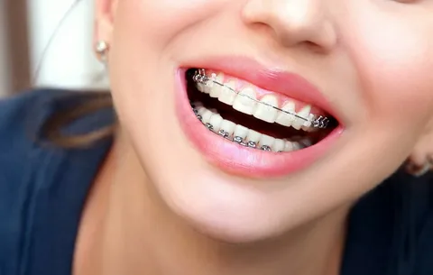 The Best Invisible Braces: What Are Their Benefits?