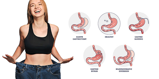 Long-Term Health Improvements After Weight Loss Surgery